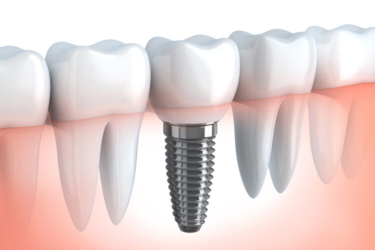 impianti dentali - carico-differito