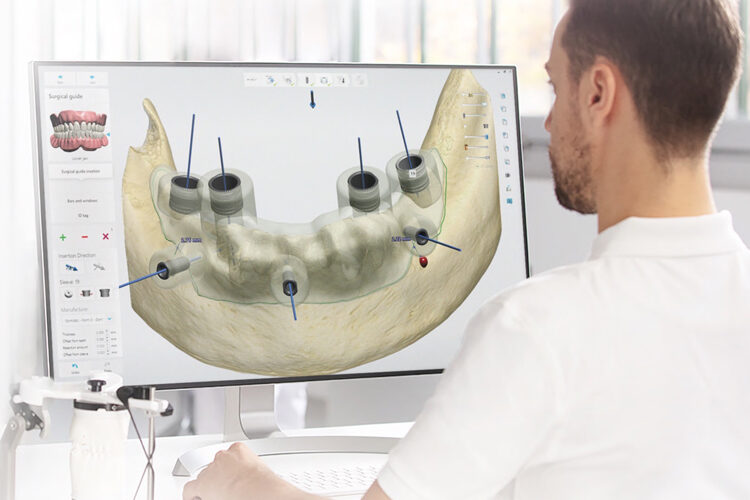 impianti dentali