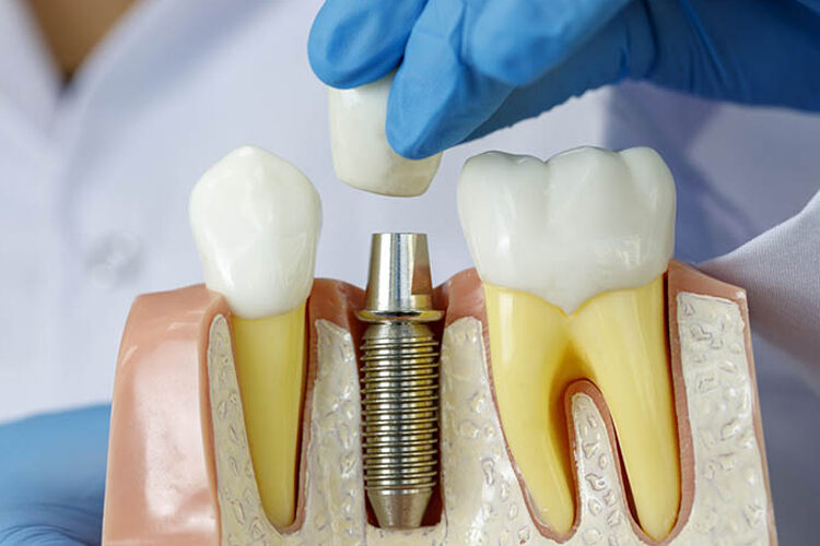 impianti dentali