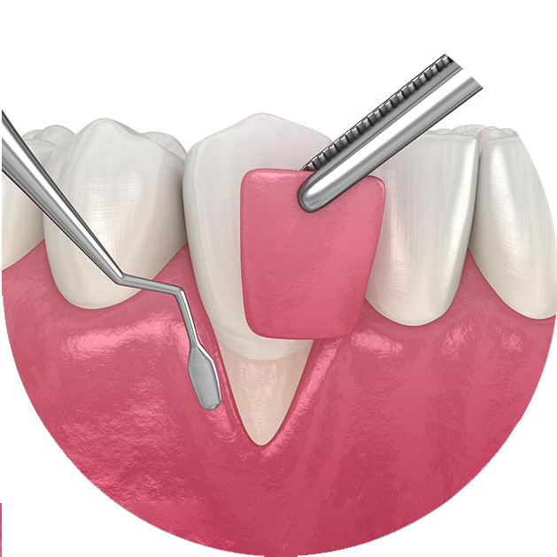 Clinica Odontoiatrica Risita - mucogengivale