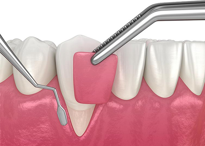 Clinica Odontoiatrica Risita - mucogengivale